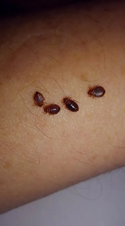 Bed Bugs In Arm