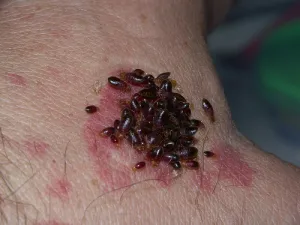 Bed Bugs Bitting