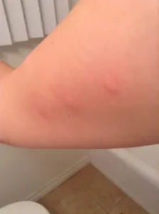 Bed Bugs Bites